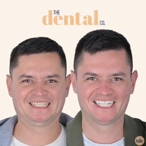 Before_and_After_face_2-min