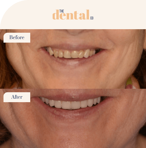 fullmouthrehabbeforeandafter