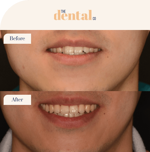 beforeandafter-invisalign1