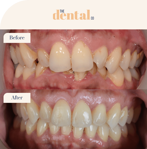 beforeandafter-invisalign3