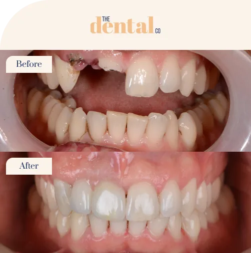 Dental Implants