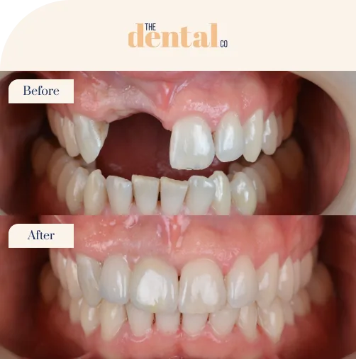 Dental-Implants