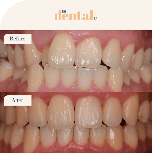 Invisalign